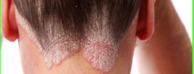 Fungal infection in scalp, then definitely do this home remedy