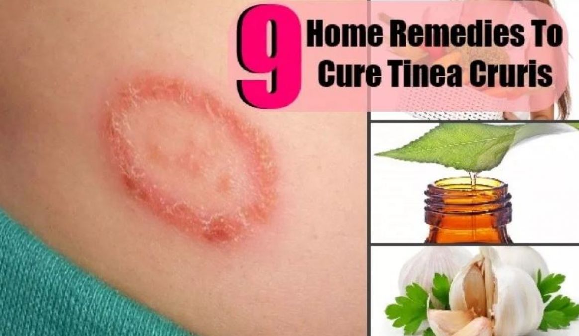 Get Rid of Herpes With Coconut Oil and Other Things, Read Household Remedies