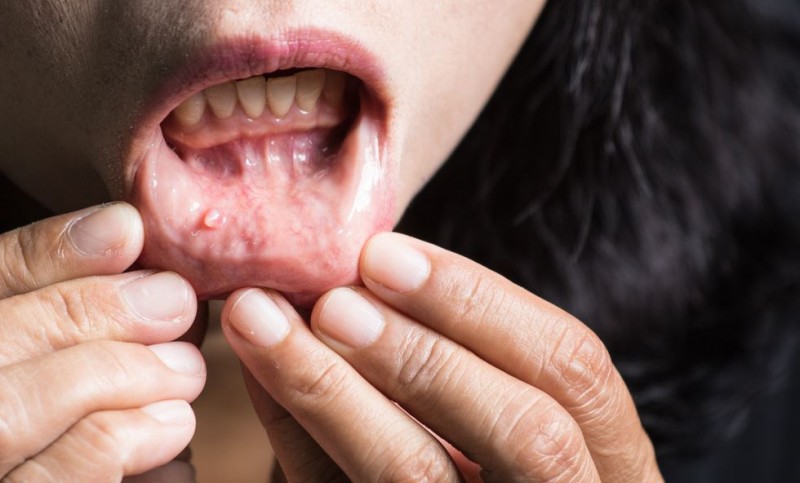 10 Home Remedies for Fast Relief from Painful Mouth Ulcers
