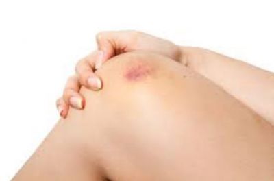 Tips to Heal Bruises Naturally With Home Remedies