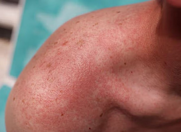 Troubled by Heat Rashes? Try These Home Remedies