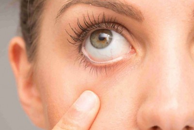 Dry Eyes Due to Hot Winds? Get Rid of Them with These Remedies