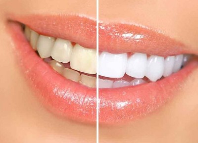How to Follow These Tricks to Maintain the Shine of Your Teeth