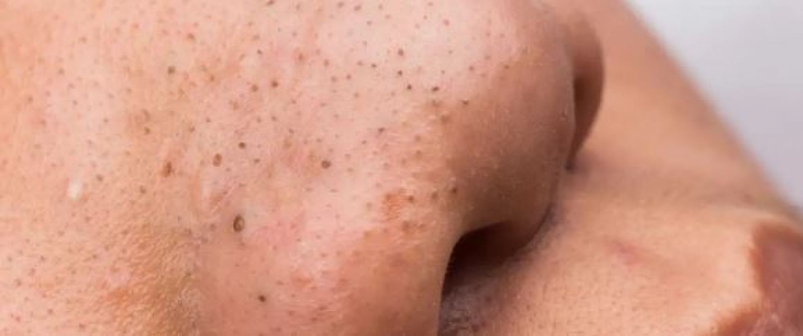 If you are also troubled by blackheads, then follow these home remedies