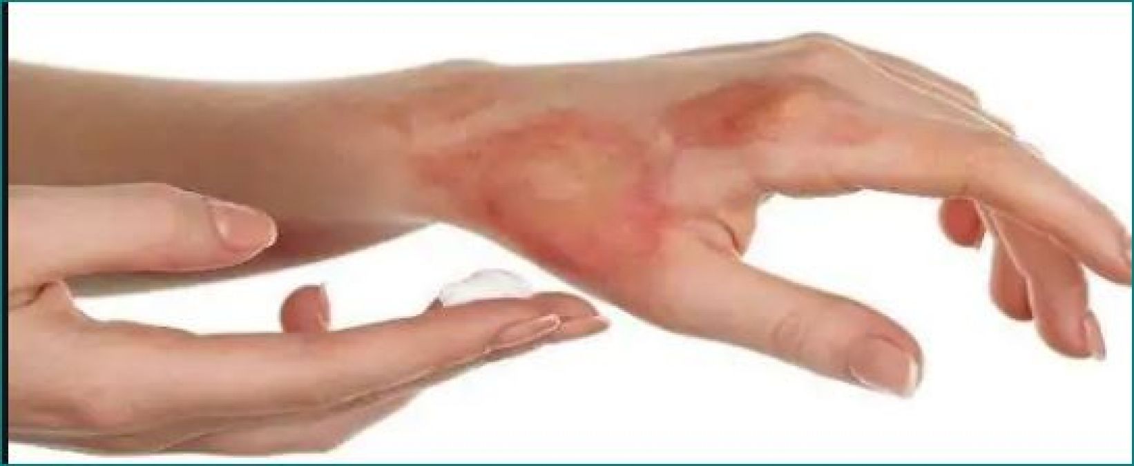 Know how to get rid of these burn marks