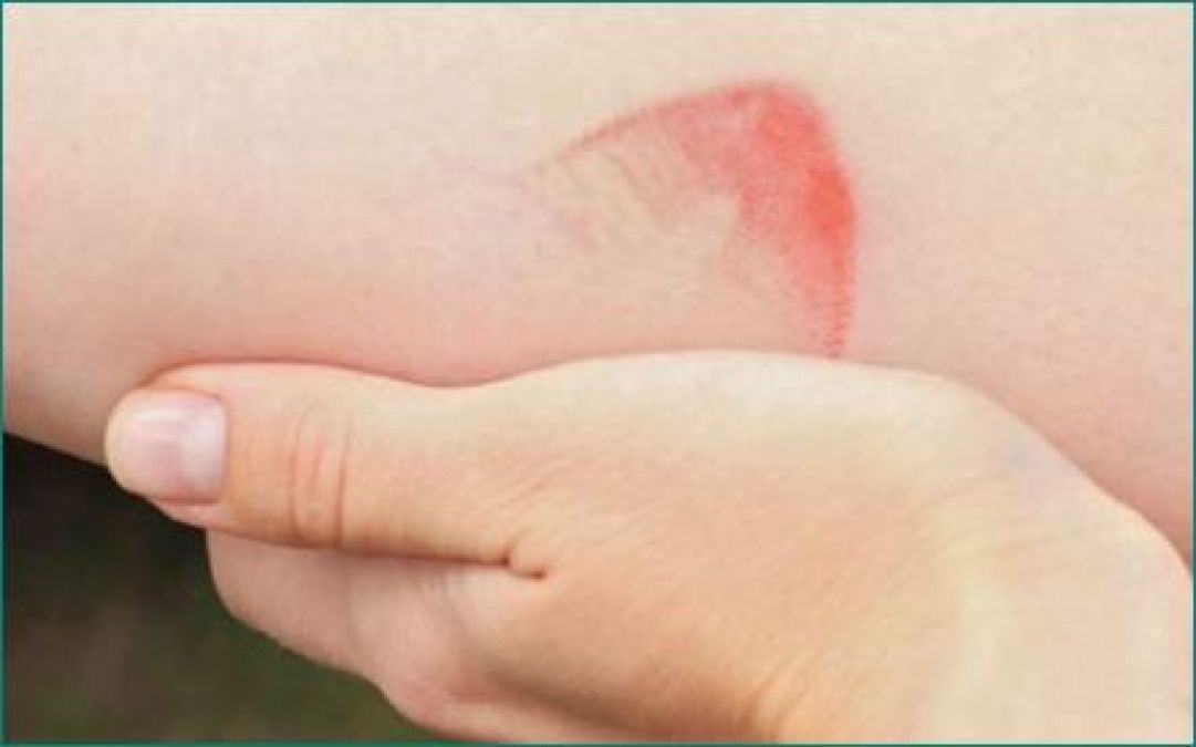 Know how to get rid of these burn marks