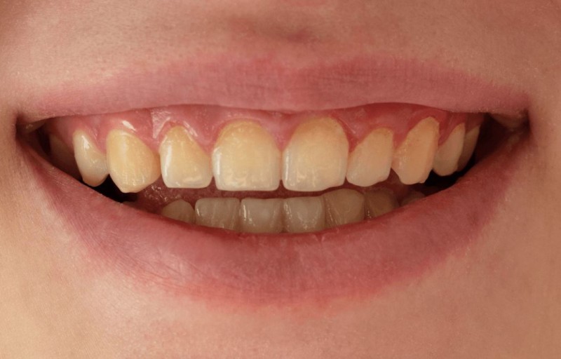 ब्रश करने के बाद भी नहीं जा रहा दांतों का पीलापन, तो इन नुस्खों से पाएं पीलेपन से छुटकारा