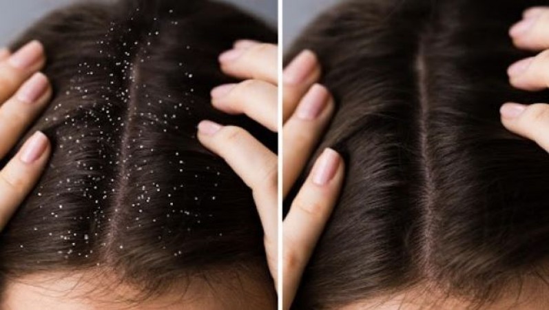 Follow this easy recipe to remove dandruff from hair; itching will also be relieved