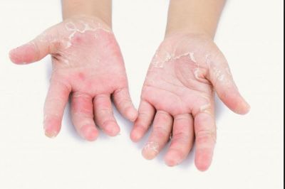 The big problem is palm skin peeling, take these measures