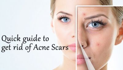 Follow these domestic methods to get rid of acne scars