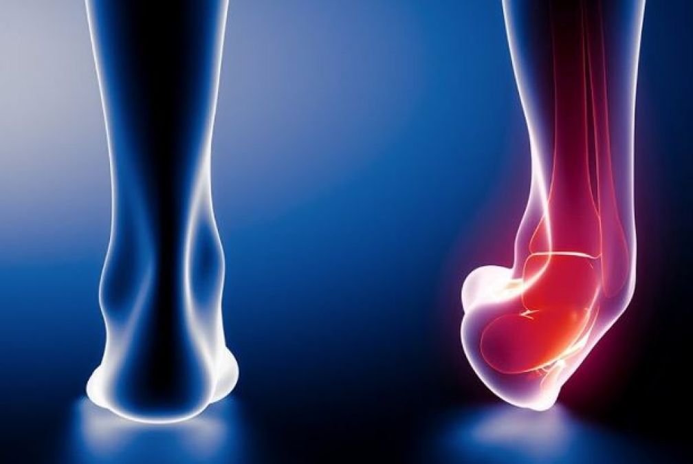 Do Treat  the heel sprain by adopting these home remedies