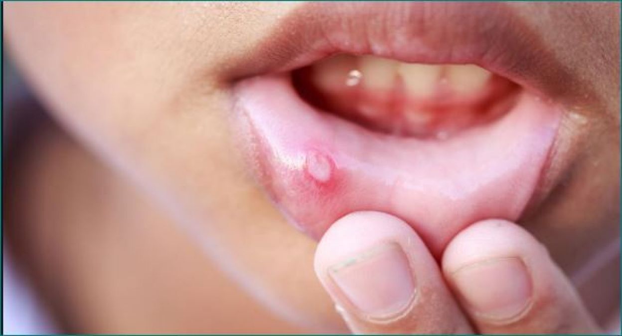 Adopt these home remedies to get rid of ulcers