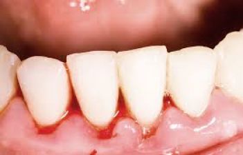 एलोवेरा पल्प से दूर करें दांतों से निकलने वाले खून की परेशानी