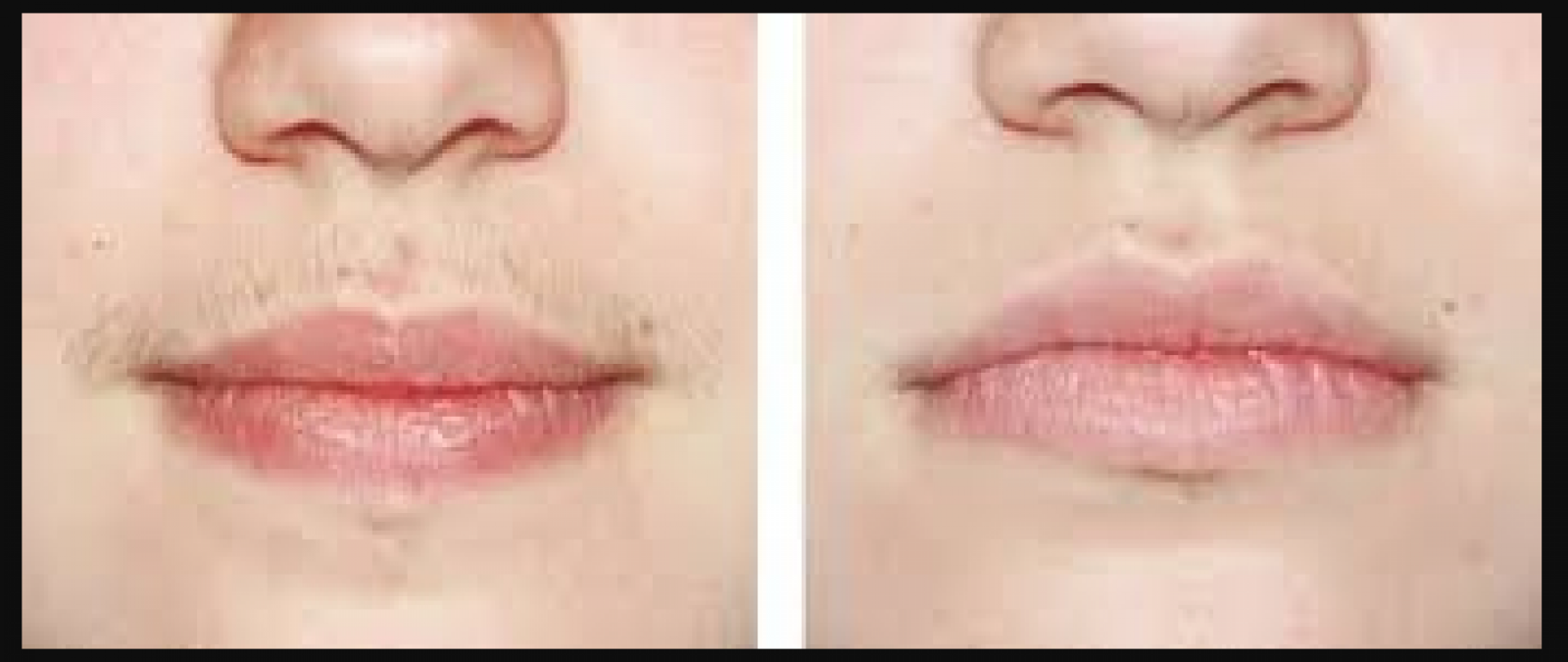 Try these home remedies to remove upper-lips hair