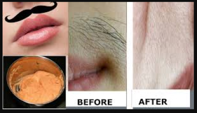 Try these home remedies to remove upper-lips hair