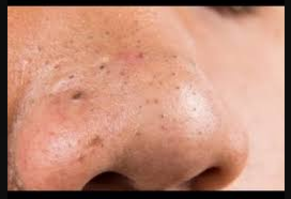 Try these home remedies to get rid of stubborn blackheads