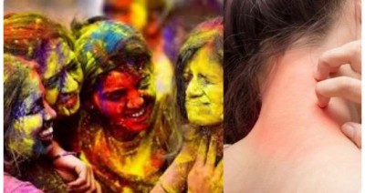 Holi color has caused skin allergy, so adopt these home remedies