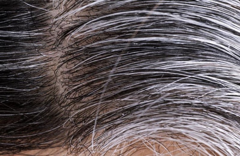 By adopting this remedy, you will get rid of white hair in a jiffy.