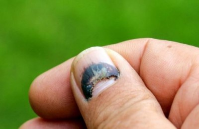 Such a identified nail injury and adopting these home remedies
