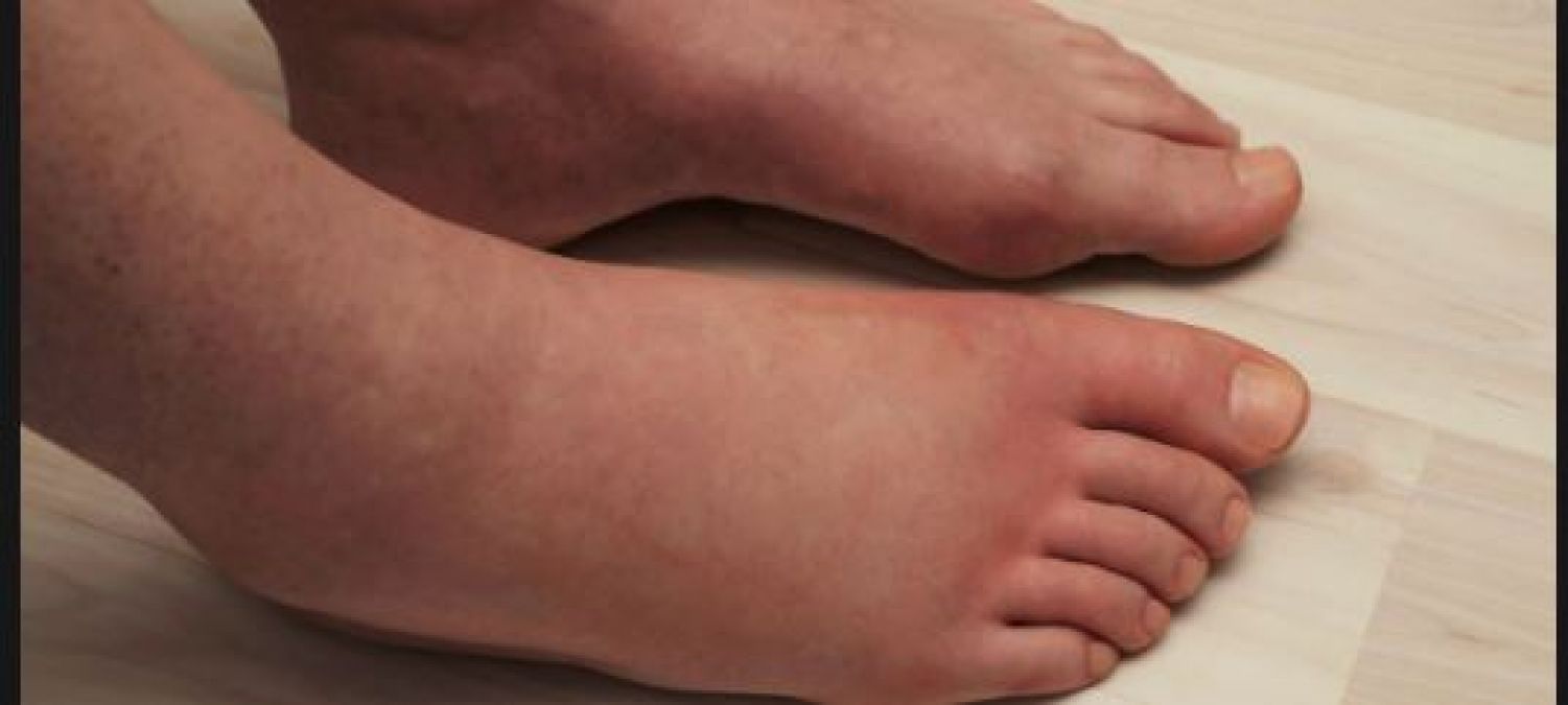 If there is swelling in the feet, then get rid of it like this