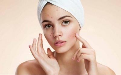 If you are troubled by pimples on your face, then follow these home remedies, you will get instant relief