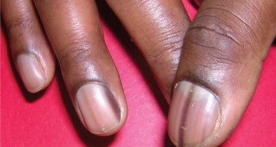 Remove the darkness on the skin near the nails like this 