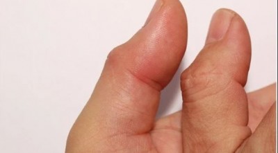 There is pain and swelling in the thumb, so adopt these home remedies