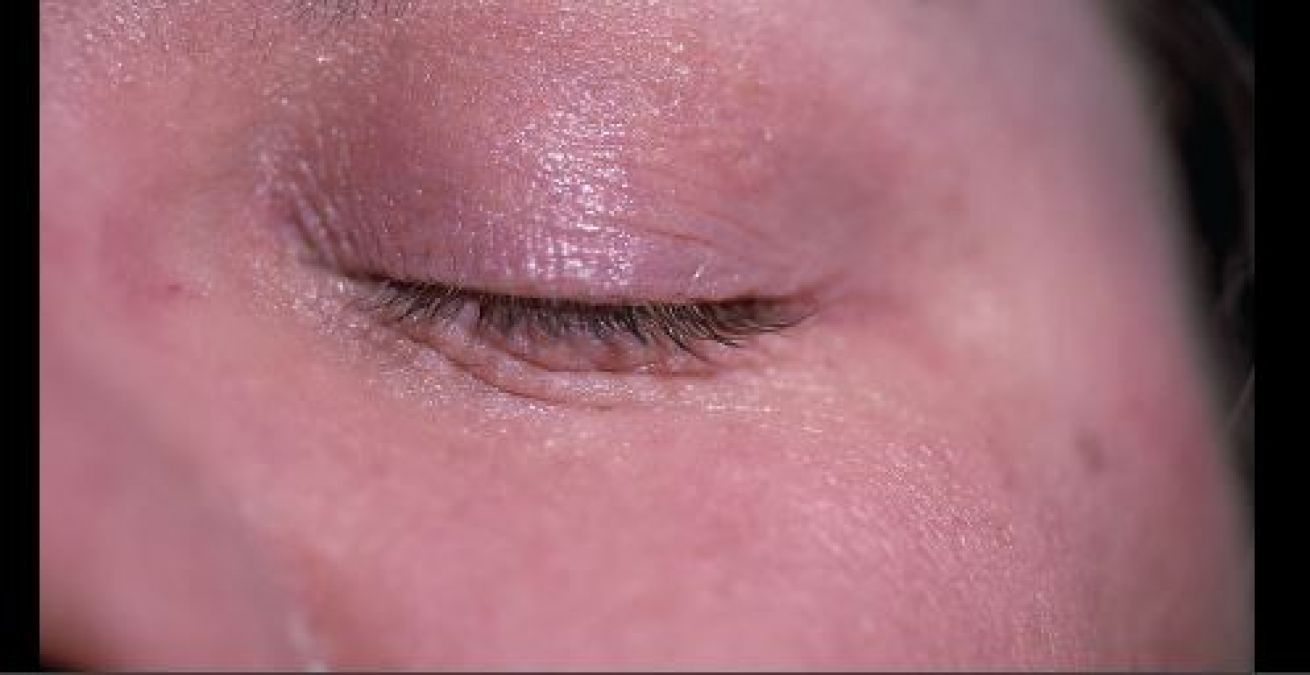 There is a recurring itching in the eyelids, so adopt these home remedies