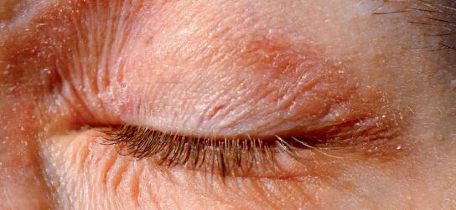 There is a recurring itching in the eyelids, so adopt these home remedies