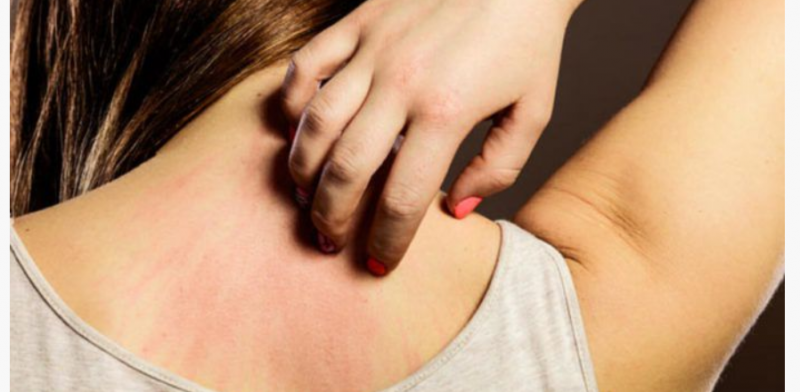 Do this home remedy to get rid of skin allergy