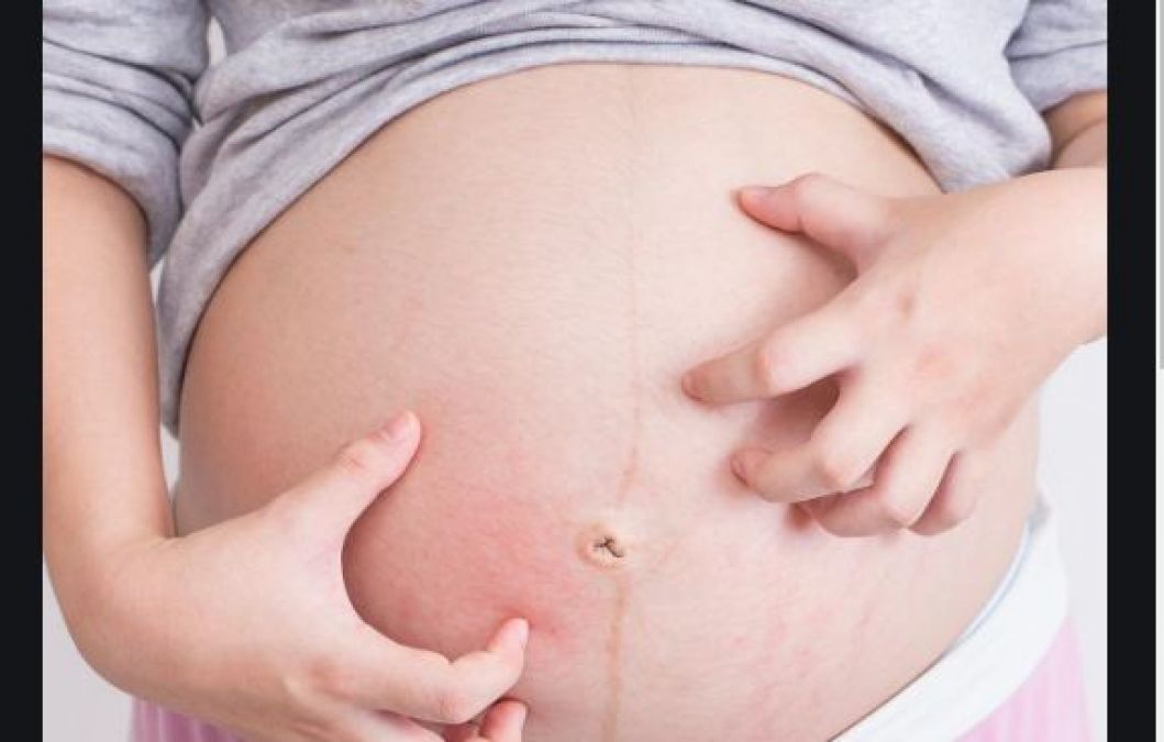 Adopt this home remedy to get rid of the itching problem during pregnancy