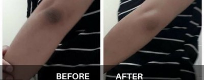 These 4 Home Remedies Will Remove The Blackness Of The Elbow In 1 Week
