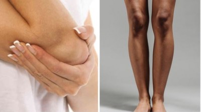Troubled by the Dark Color of Your Knees and Elbows? Here Are Tricks to Get Rid of Them