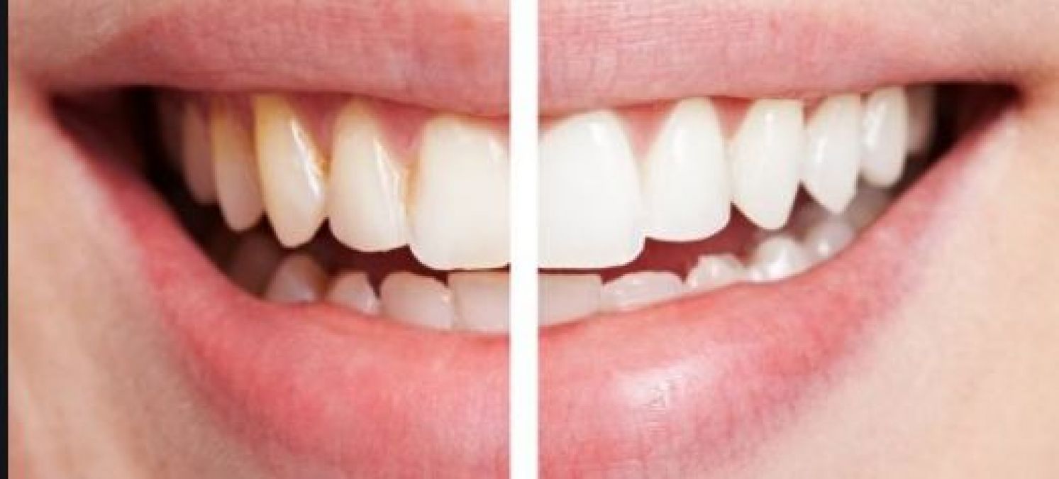 Adopt these remedy to get clean and white teeth