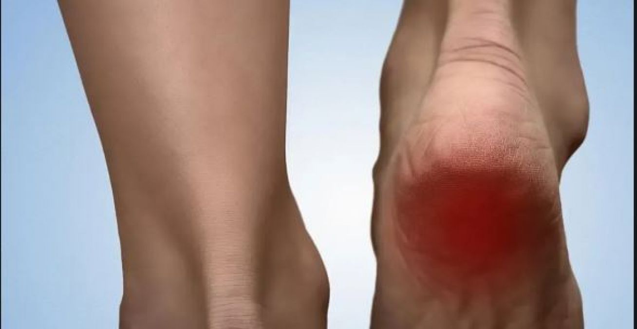 Troubled by swelling and pain in the heels then follow these home remedies