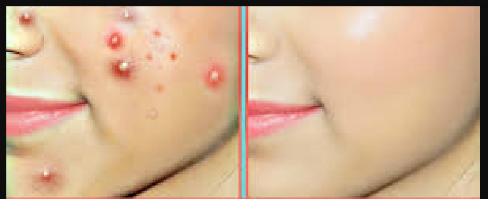 Troubled by the problem of pimples, this domestic recipe will give relief