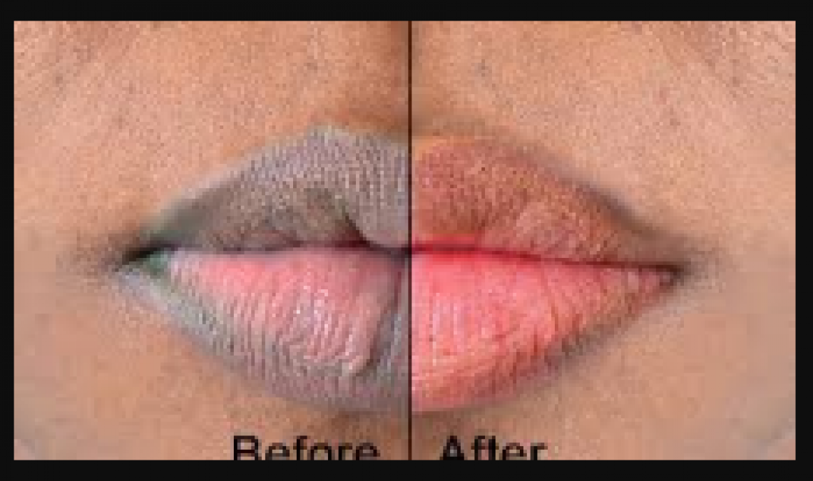 Get rid of black lips in just two days with this amazing remedies