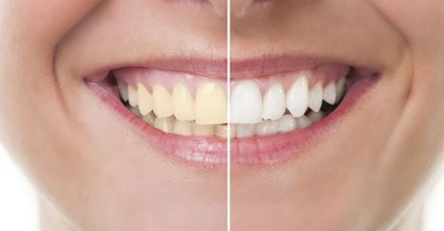 If you are not worried about yellowing and tingling of teeth, then follow these tips today.