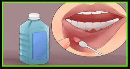 Try these home remedies to cure mouth ulcer