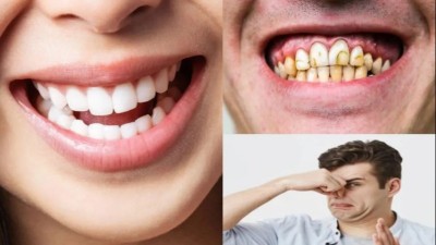 Follow These Tips to Brighten Yellow Teeth and Get Relief from Mouth Odor