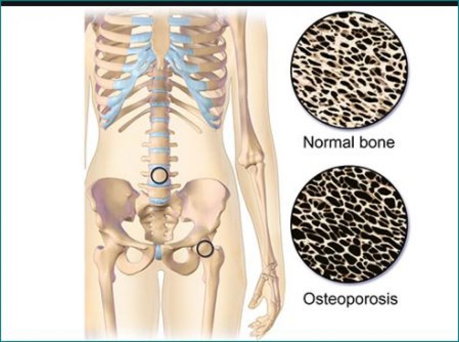 World Osteoporosis Day: Avoid these things in day to day life