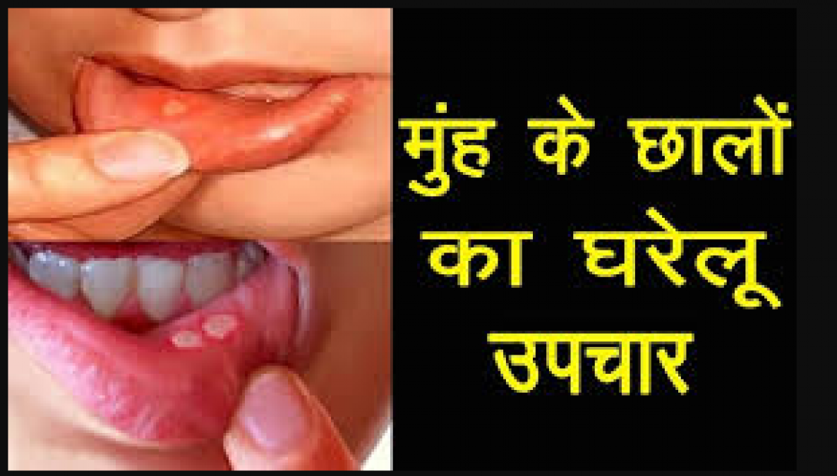 If you are troubled by mouth ulcers, then follow this home recipe