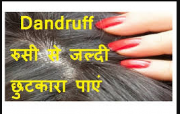 Follow this home remedy to remove dandruff