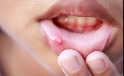Easy 6 ways to get rid of mouth ulcers