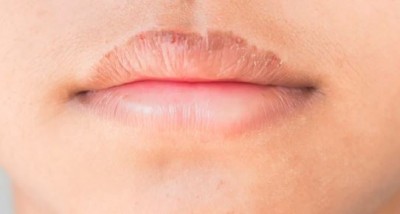 Follow these tips when lips burst