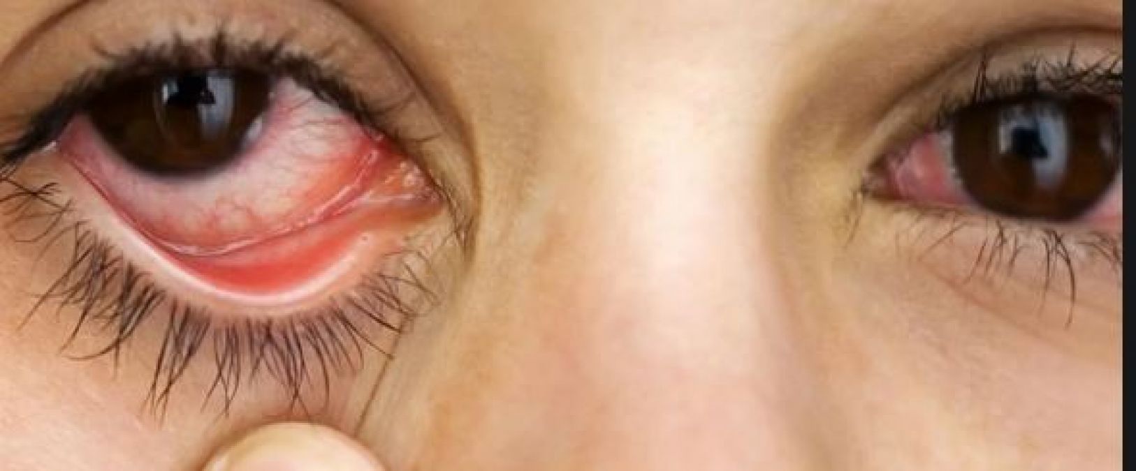 सुअर की त्वचा से लौटी 20 मरीजों की आंखों की रोशनी!