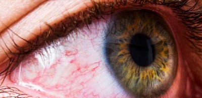 These 3 signs in the eyes show that your Cholesterol Level has increased