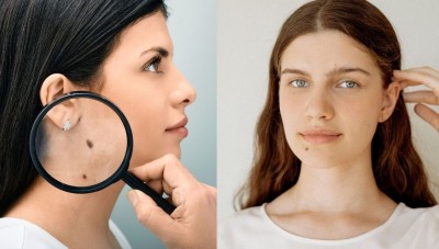 Is There a Real Connection Between Facial Moles and Your Personality? Find Out Here