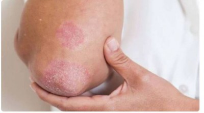 Has fungal infection on the skin, so don't do these 5 mistakes