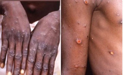 'Monkeypox spreading from the air', expert gives this special advice